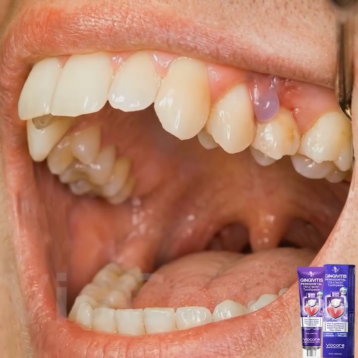 Gum Healing Endorsed by the Academy of Periodontology (AAP) | Full refund guarantee