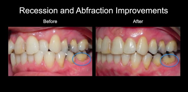 The Aligner Selection System