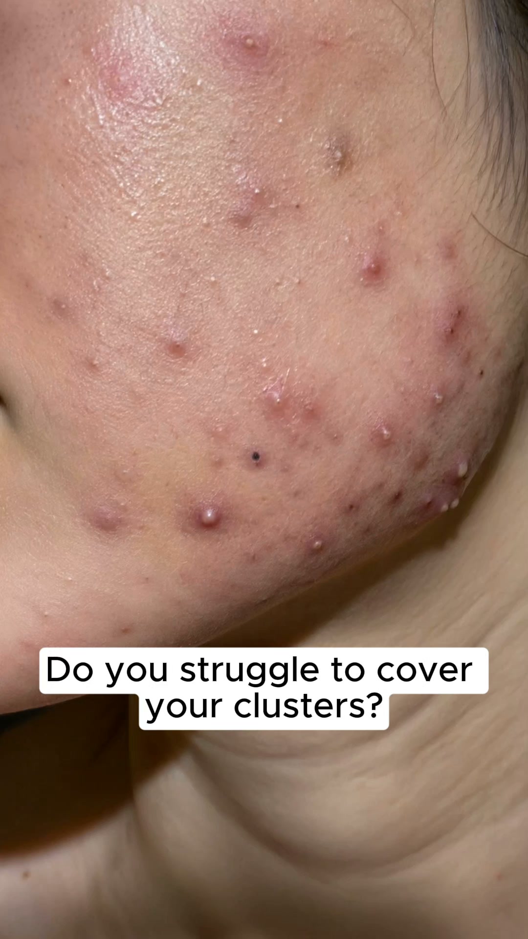 ClearTheory Is Solving Ireland's Biggest Pimple Patch Problem