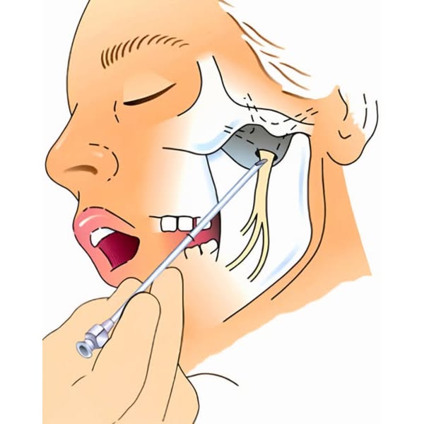 I charge £150 for a migraine infusion. My patients keep asking about the £25 roll-on sitting at reception.