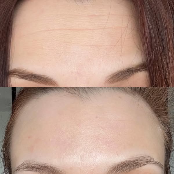 You Won't Need Botox After You Read This