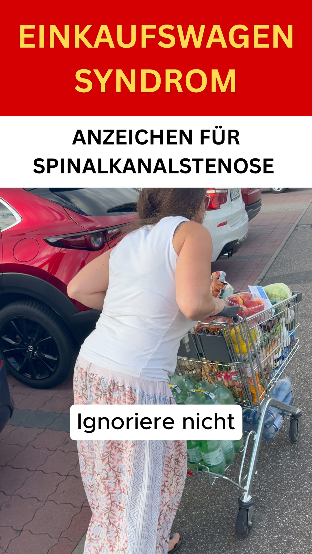 Das Einkaufswagen-Syndrom, das auf Spinalkanalstenose hinweist