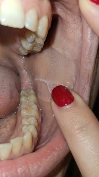 Fluoride Rinse Can't Fix What Mounjaro, Ozempic, And Wegovy Broke