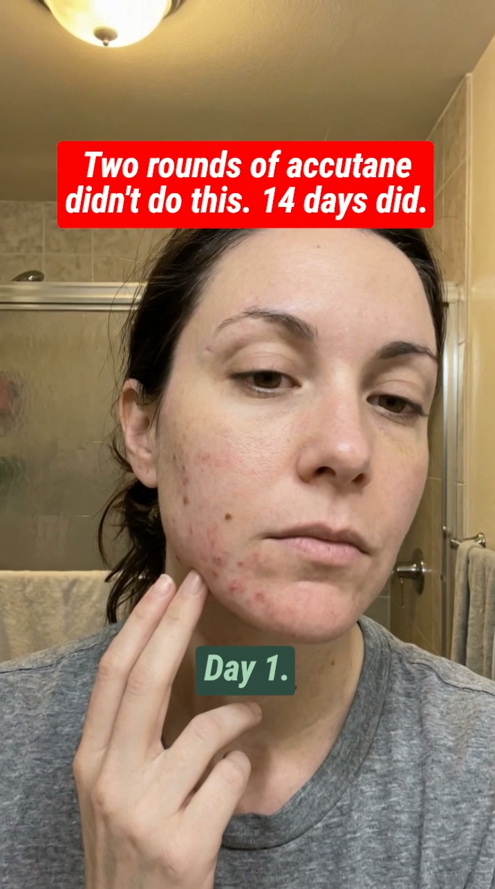Break The Acne Cycle