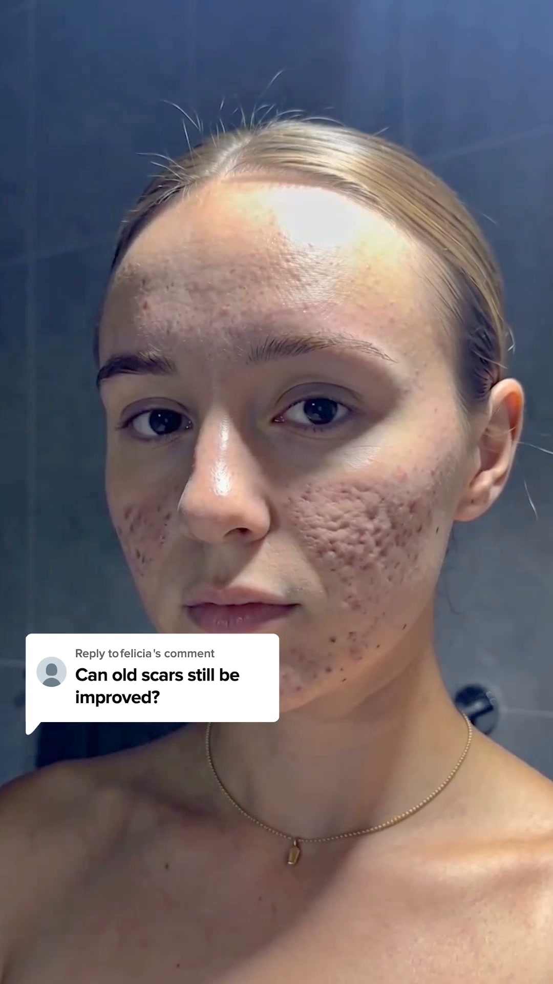 Fading Acne Scars Got Easier