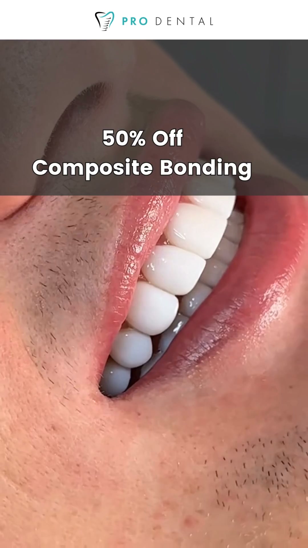 Up to 50% Composite Bonding and Veneers