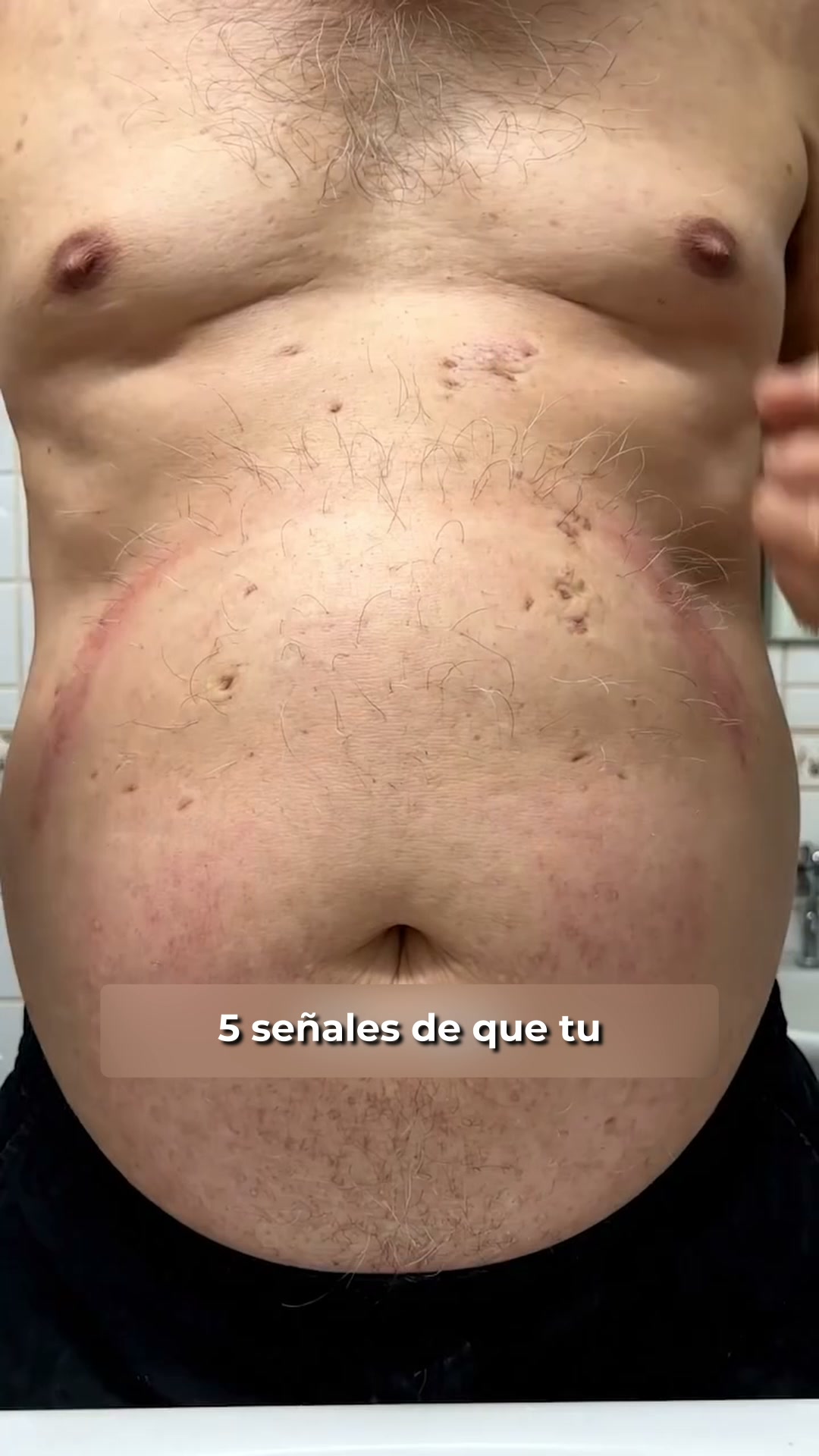 Esteato-hepatitis: lo que tu médico quizás no te explicó