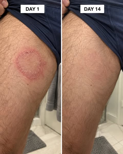 My Dad Hid This Rash For 6 Years. This Is What Finally Worked.