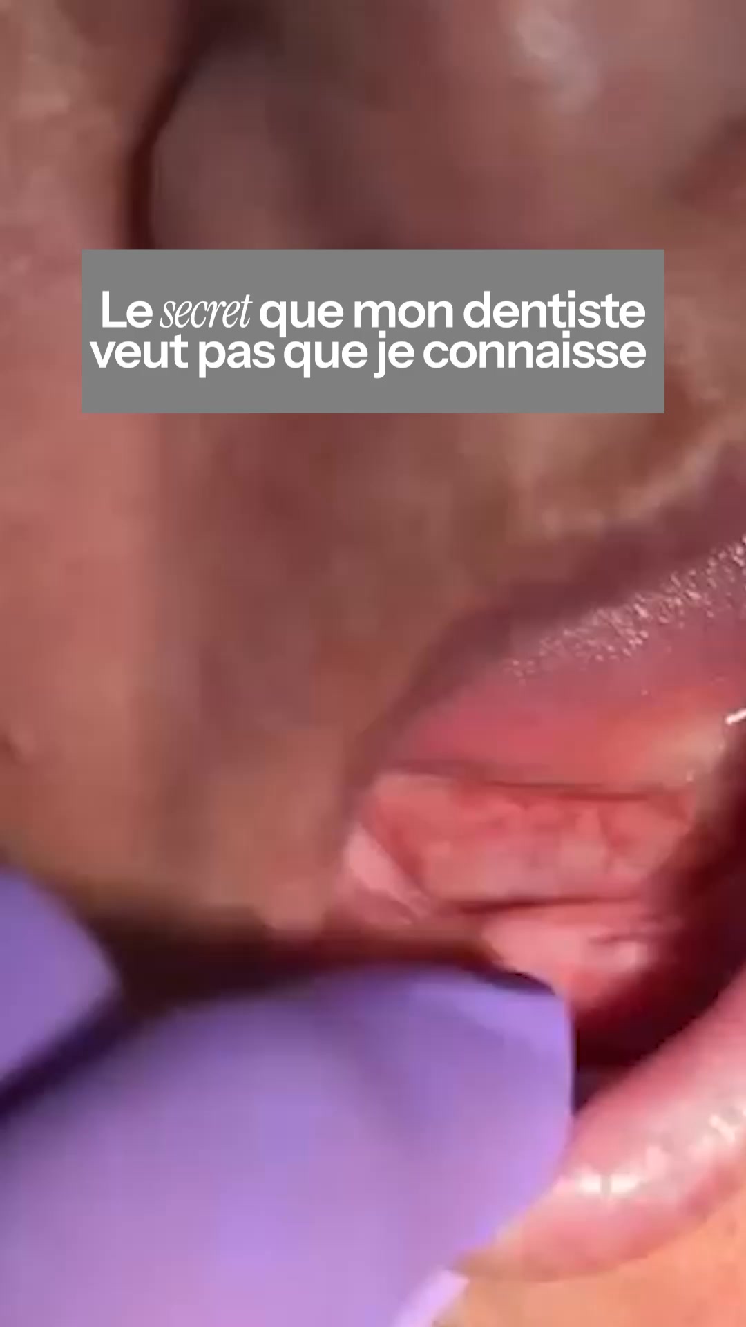 Un sourire naturel instantanément!