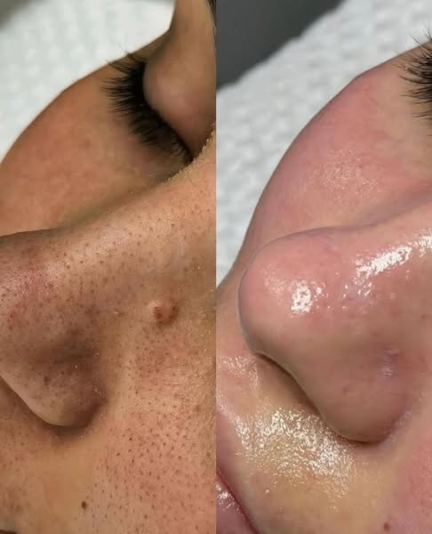 Peel Shot coréen – Désobstrue les pores, lisse la peau et ravive l’écl