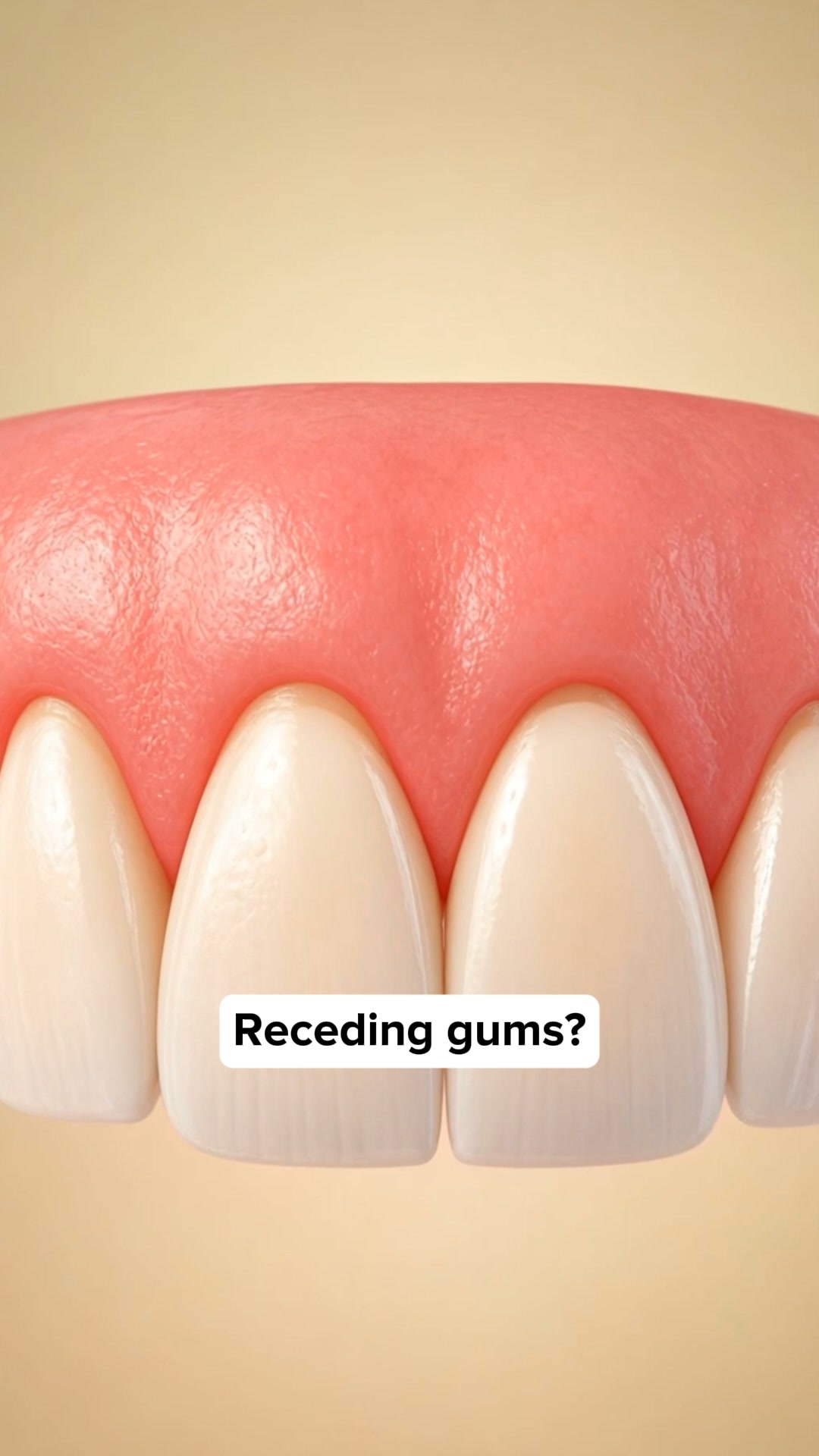 My Gums Kept Pulling Back