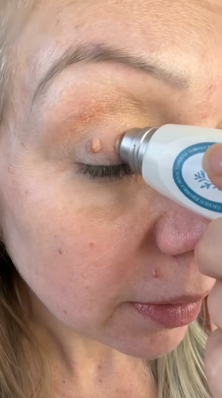 Bye-Bye Skin Bumps! Hello Smooth, Even Skin