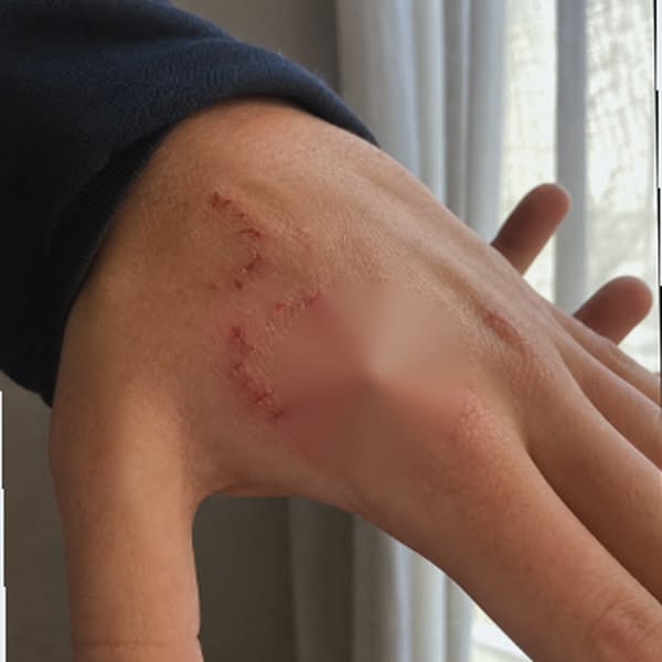 I Picked My Dog Up Wrong. He Turned And Bit Me. Hard.