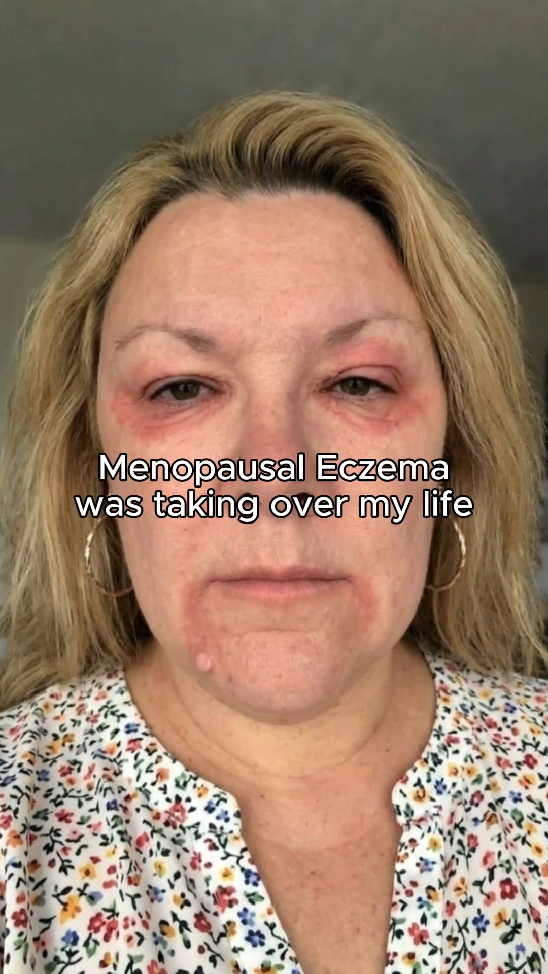 Restore Your Skin in 3 Weeks!