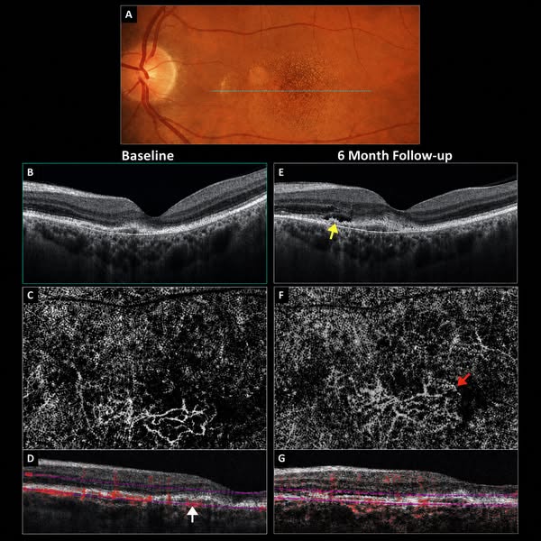 Fight Back Against Macular Degeneration!