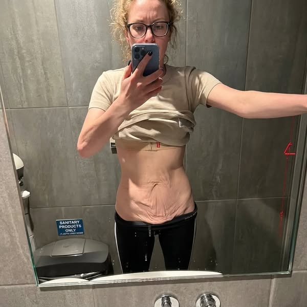 Slapp hud? Se skillnaden på bara 7 dagar med elastelle