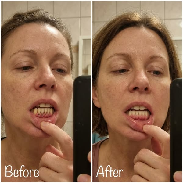 Read this if your gums are receding