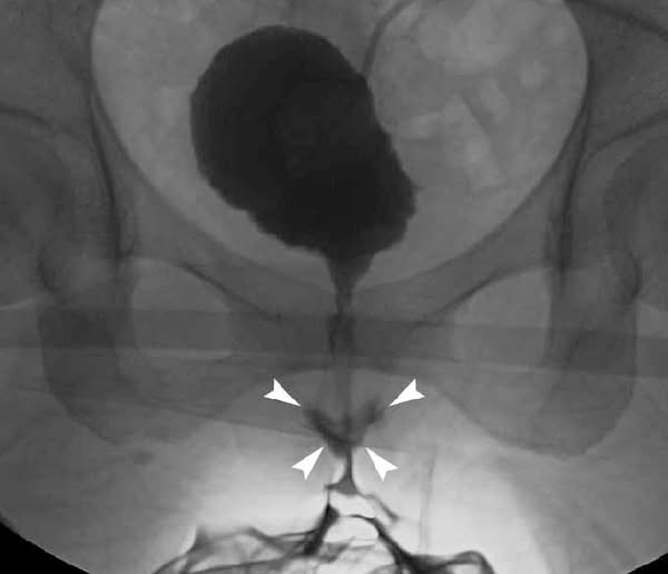 Every woman with recurring UTIs needs to see this