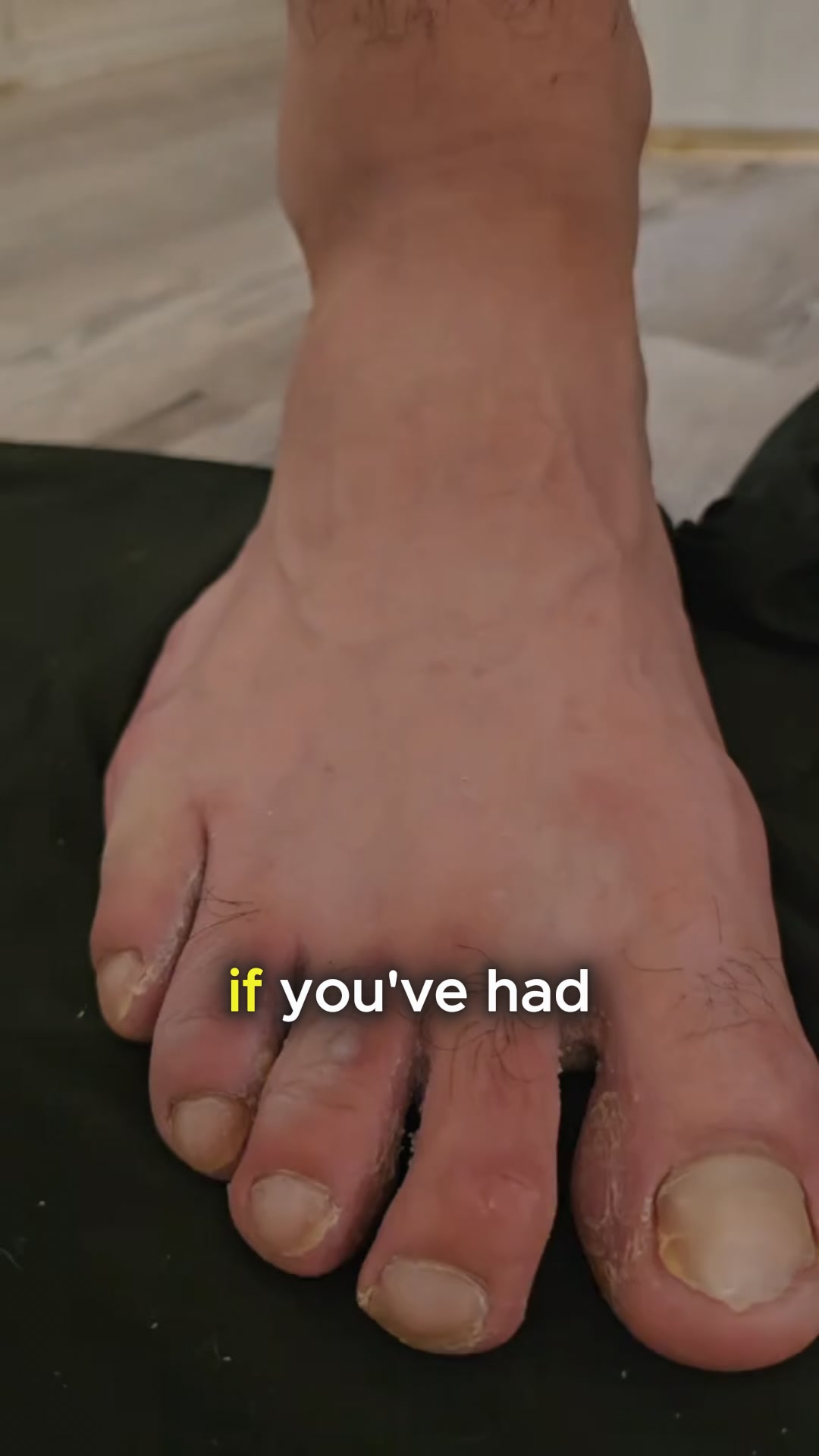 Eliminate Athlete's Foot Today.