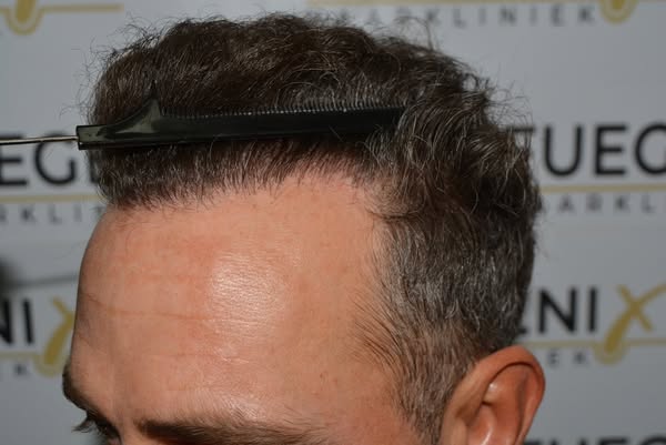 FueGenix | Exclusive Hair Transplant