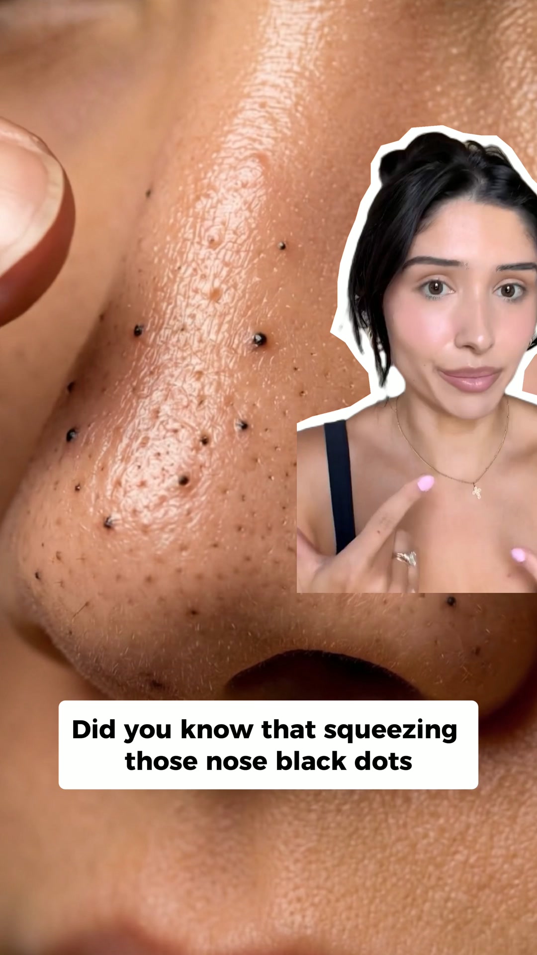 Eliminate Blackheads - Fast
