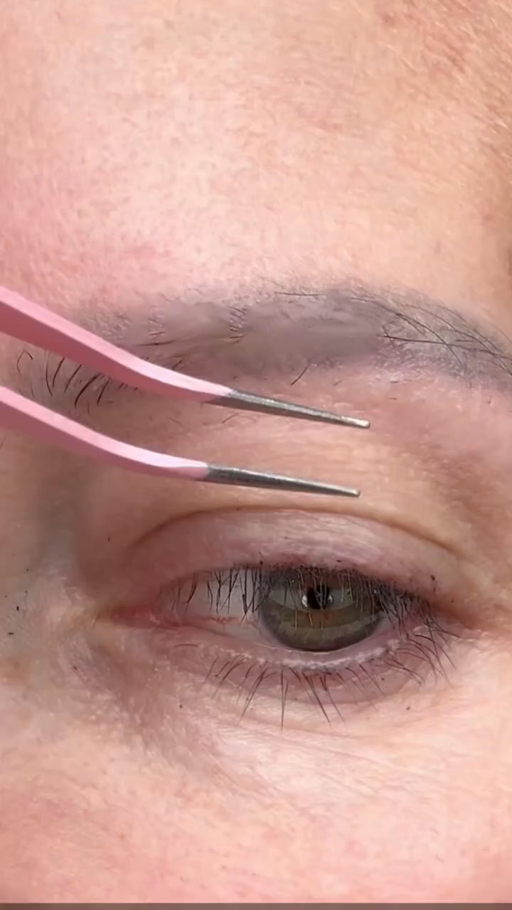 Donnez à vos paupières une chance avant la chirurgie