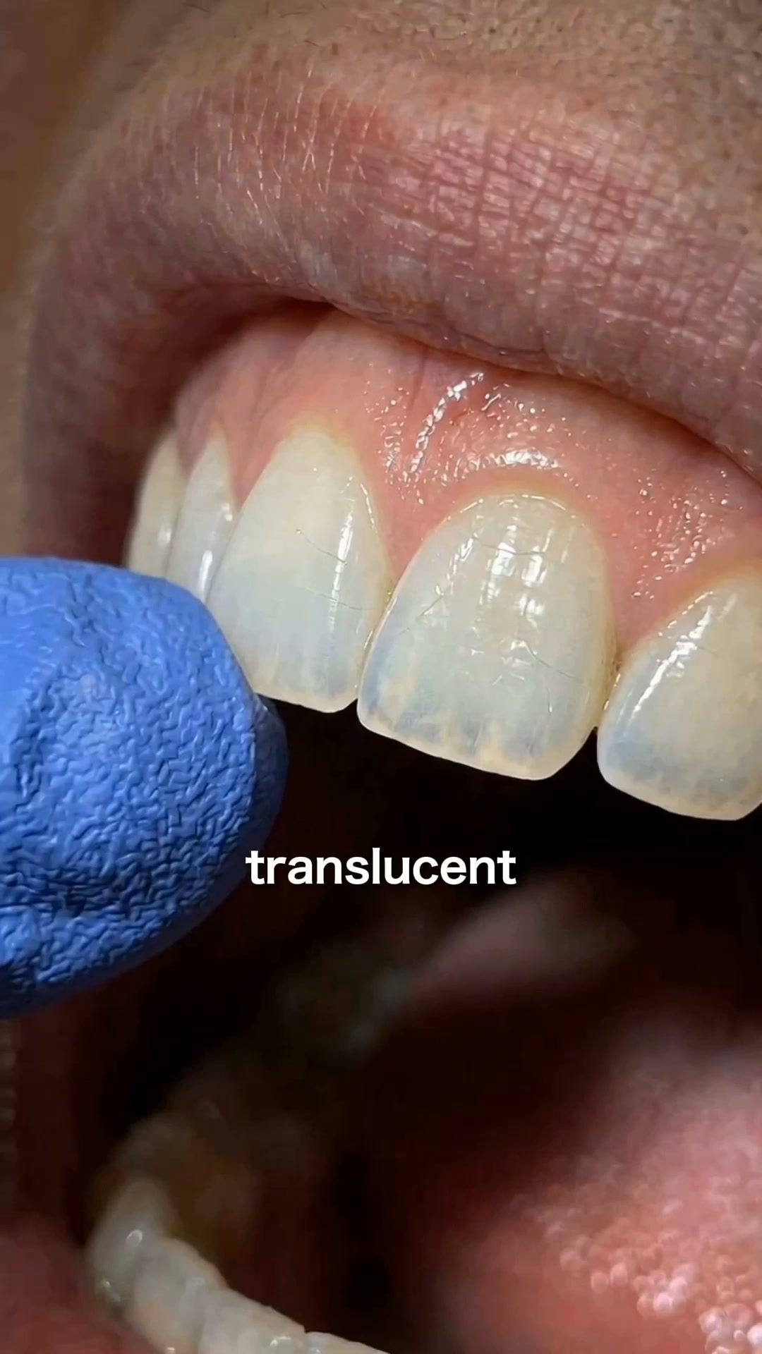 Whiter & Stronger Teeth