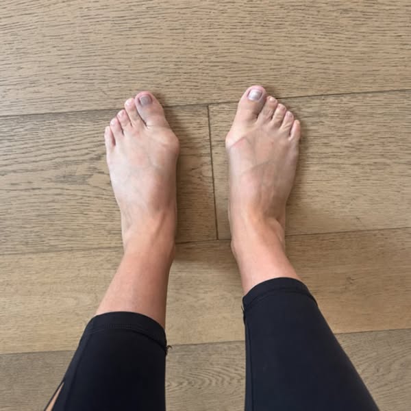 Read This If Your Shoes Hurt Your Bunions