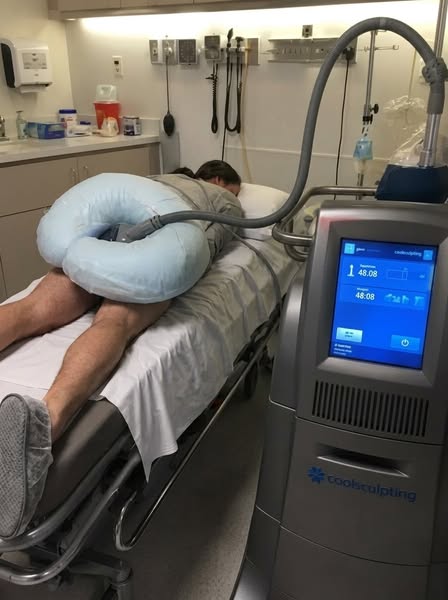Hemorrhoids Are Collagen Failure?