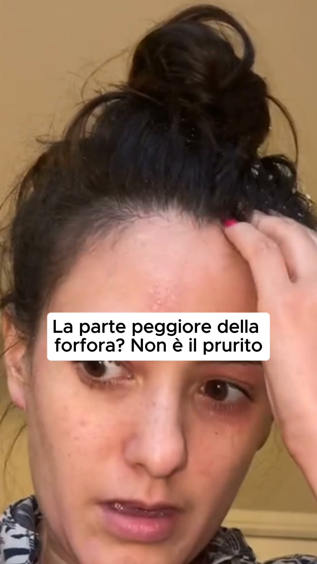 Dì addio alla forfora per sempre