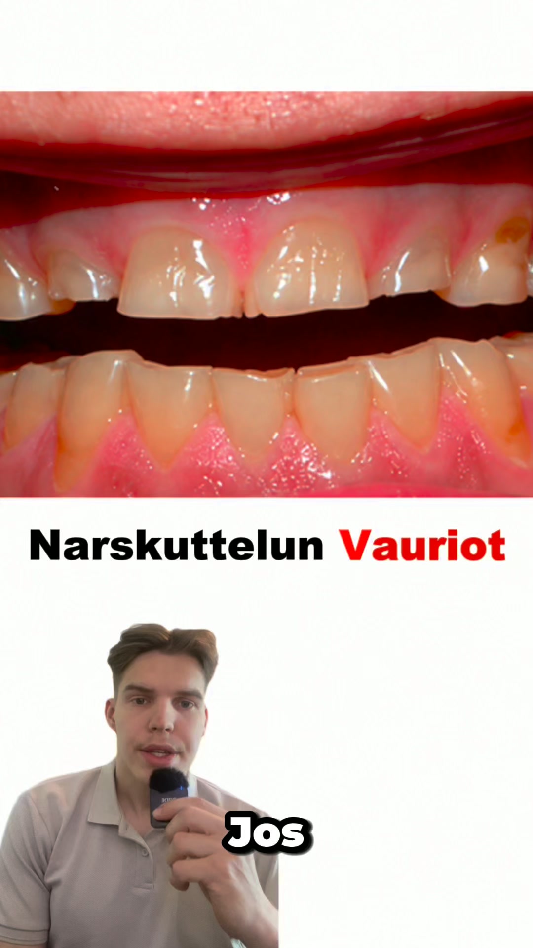 Hammaskiille ei uusiudu