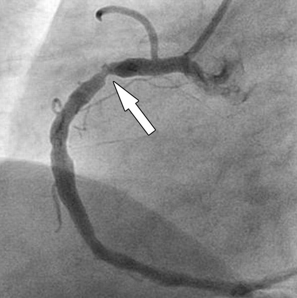 75% of Heart Attacks Happen to People With "Normal" Cholesterol