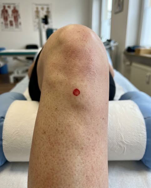 Dieser rote Punkt ist der einzige Grund, warum dein Knie wehtut