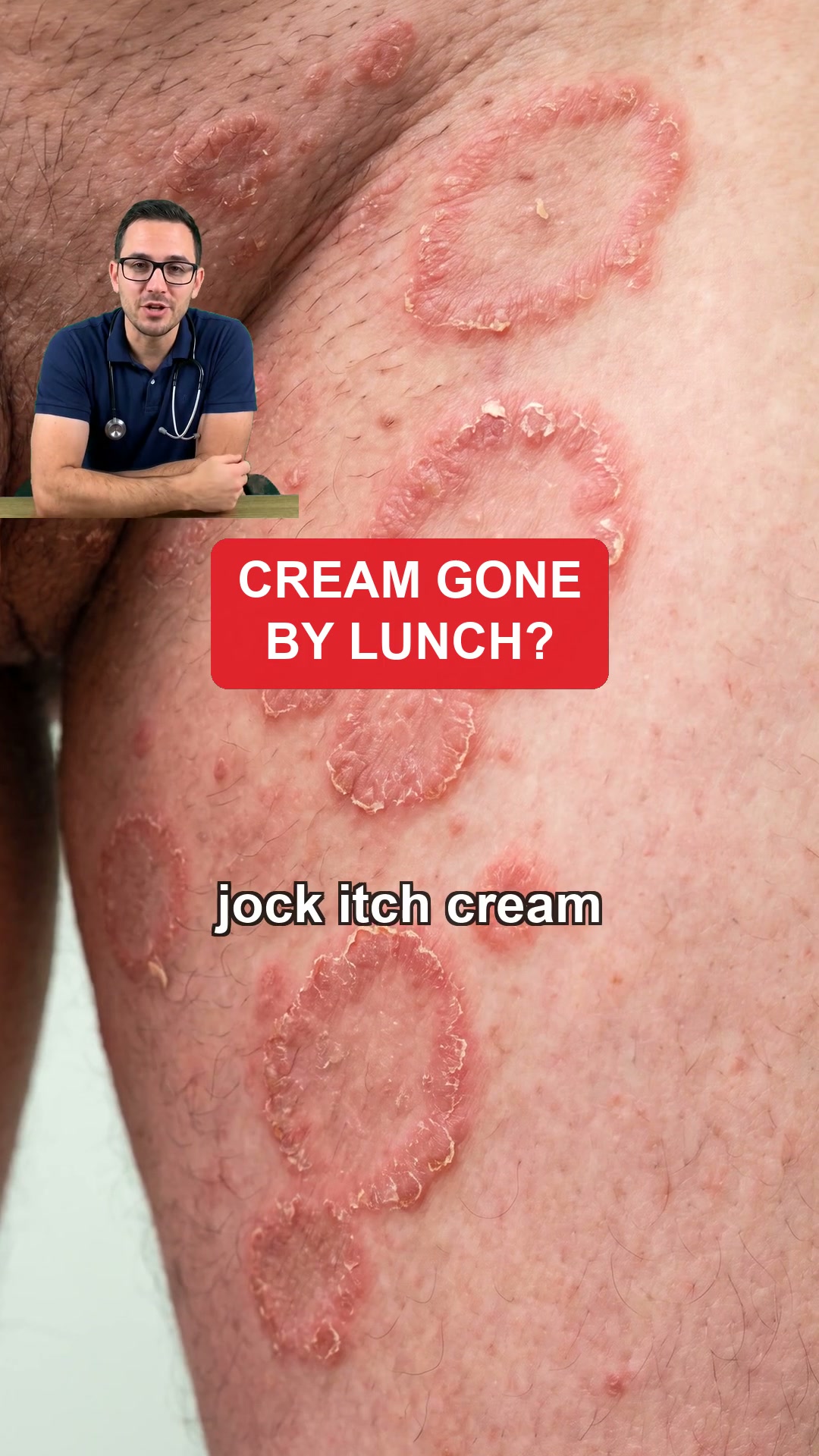Jock Itch Back By Lunch? Here Is Why