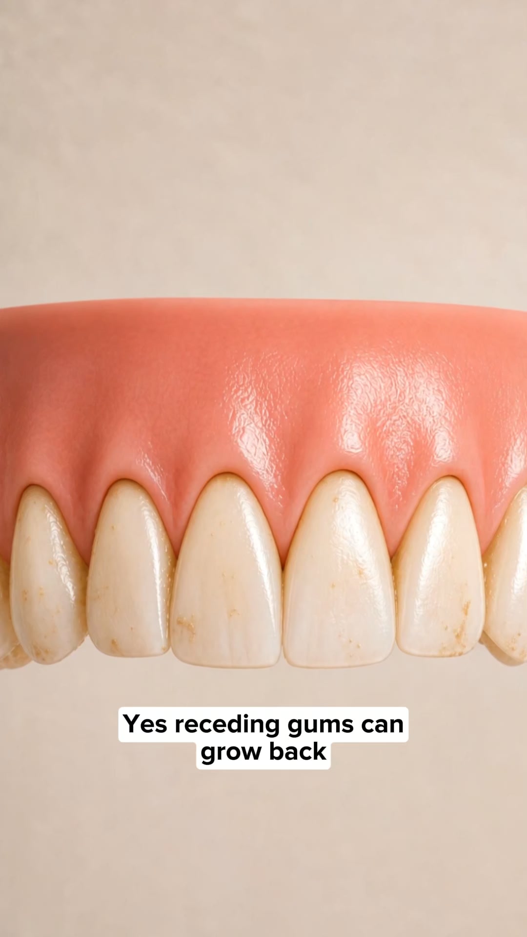 My Gums Kept Pulling Back