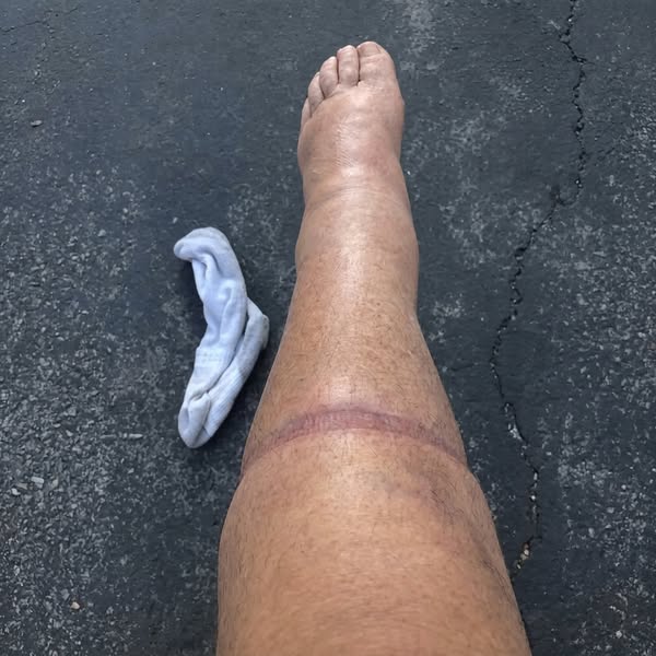 "5 years of oedema swelling gone in 1 month?"