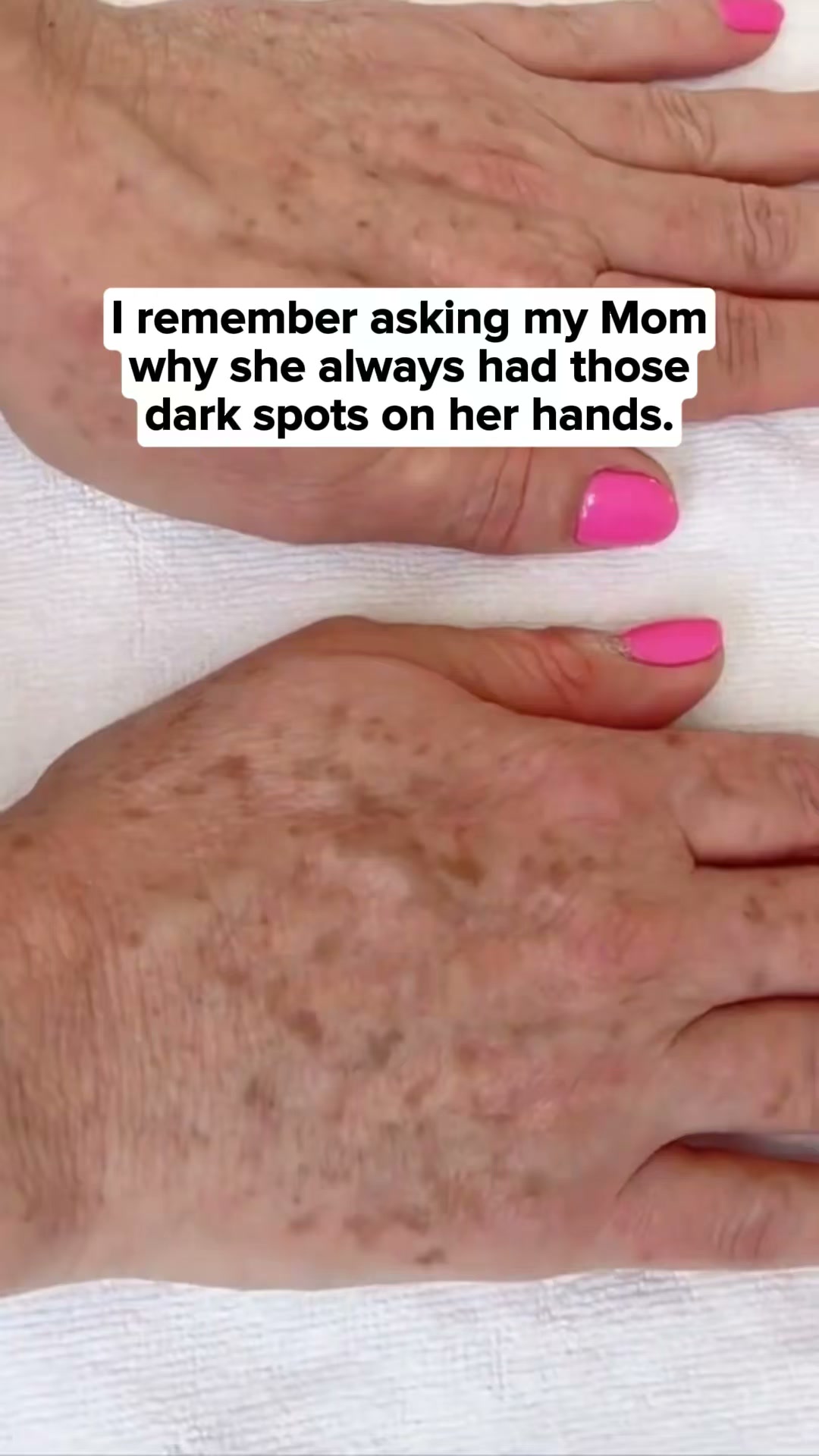 Designed for Age Spots.