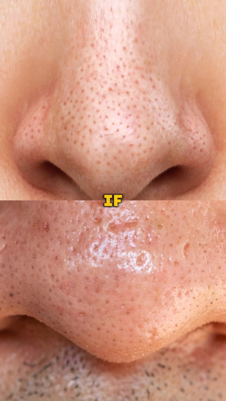 No More Nose Bumps