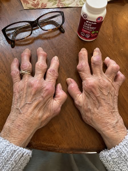 Get Your Life Back From Gout