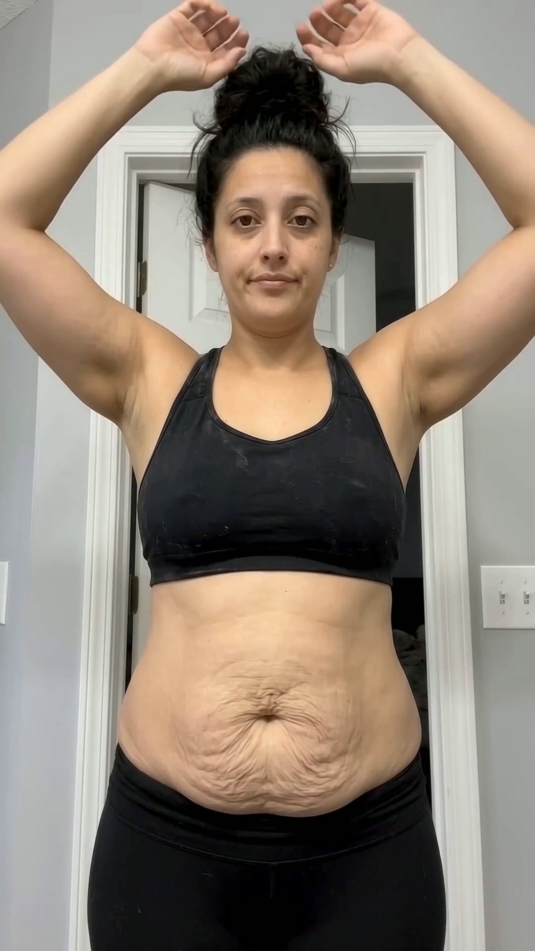 Read this before if you have stretch marks.