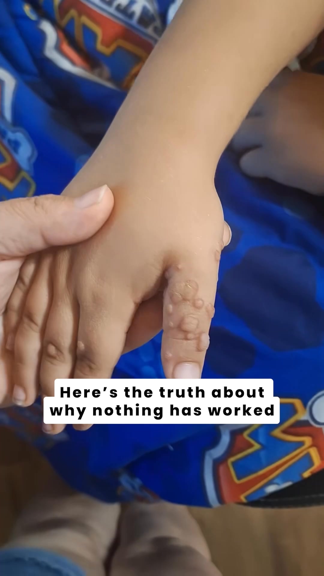 A Solution For Warts That Works