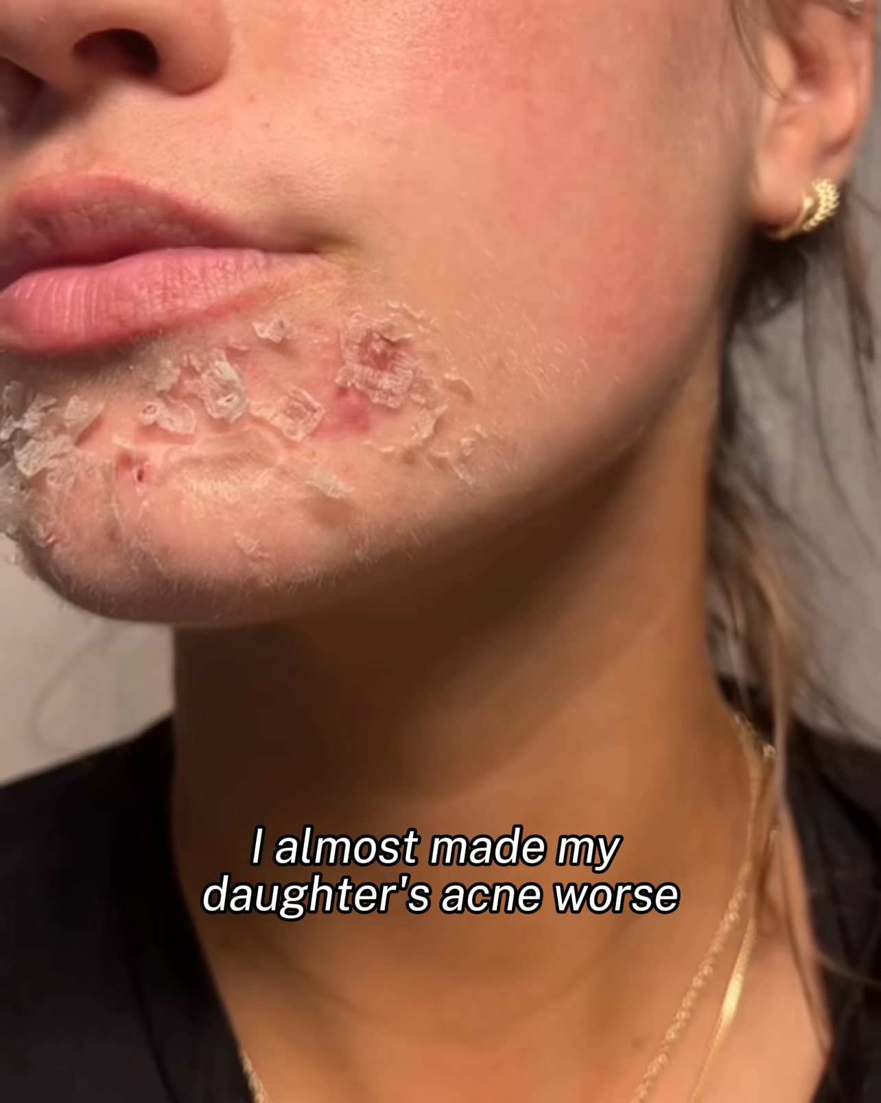 Stop acne now!