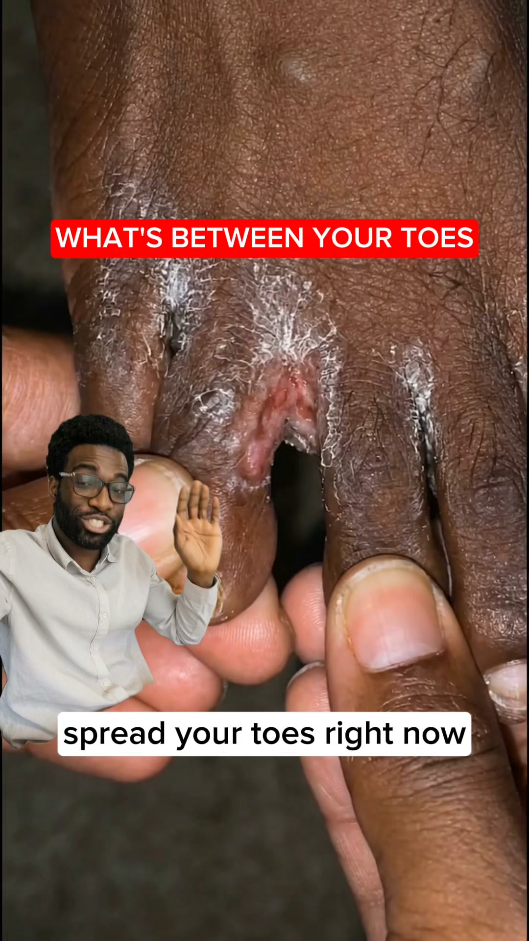 Goodbye Athlethe’s foot