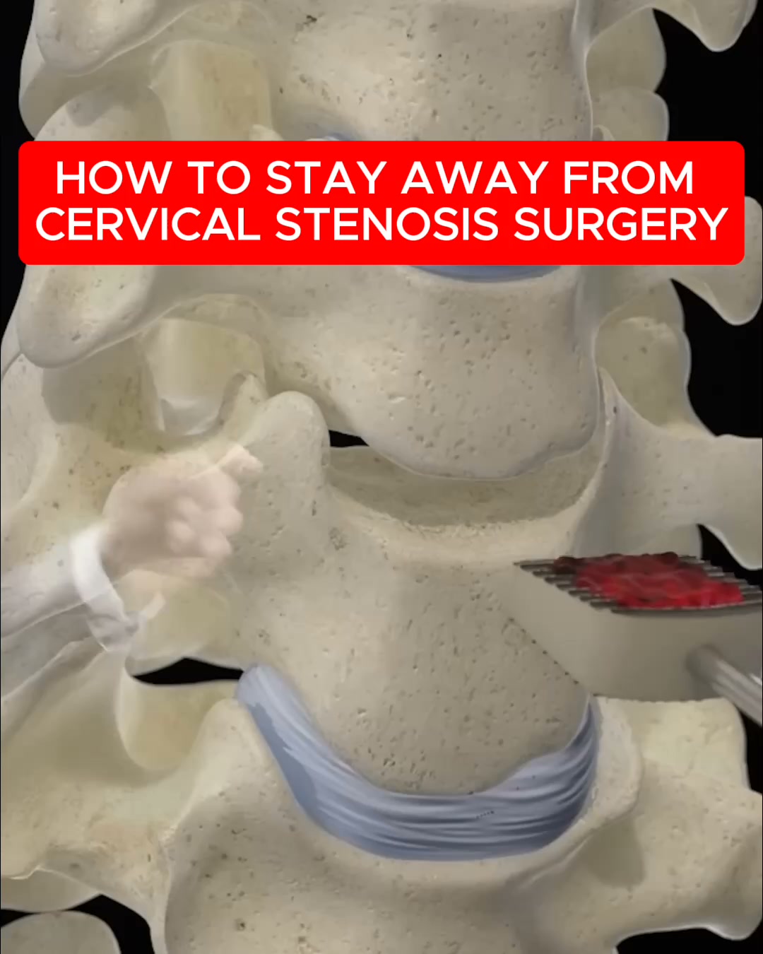 The Overlooked Muscle Behind Cervical Stenosis