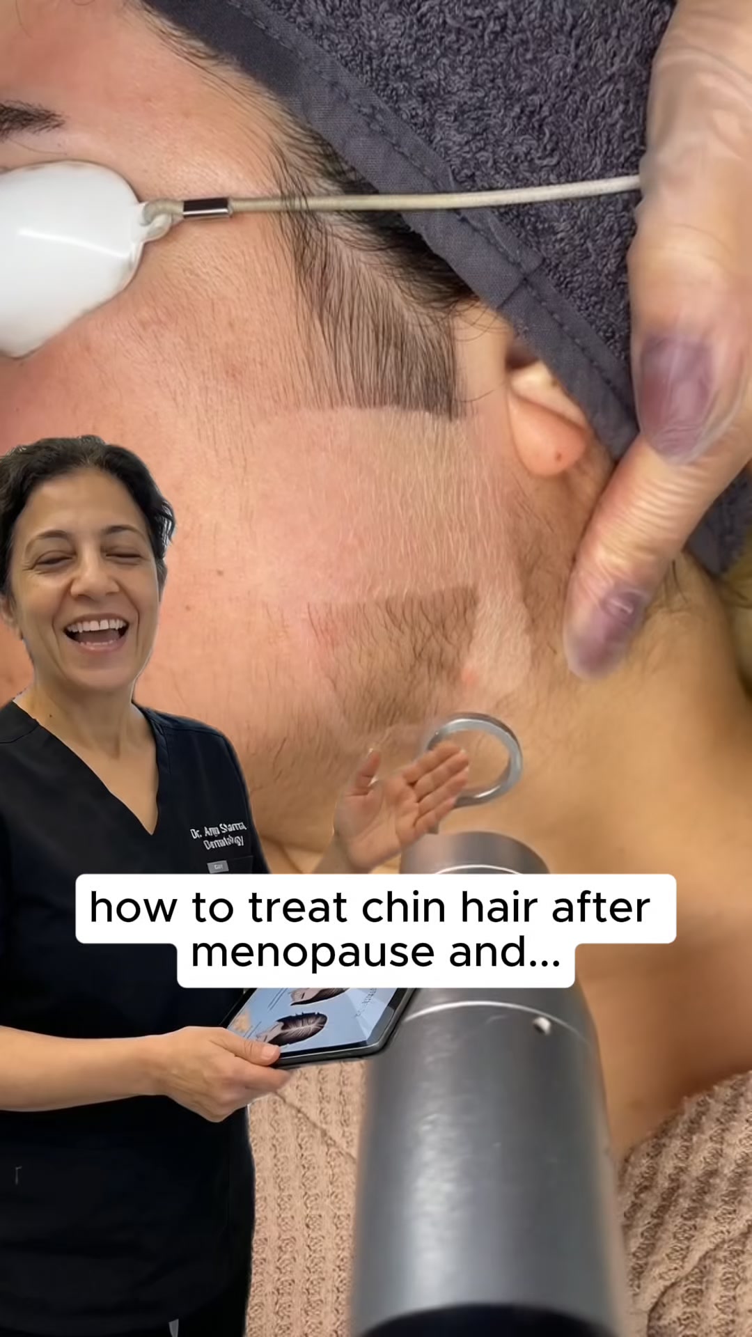 Stop your chin hair from growing back.