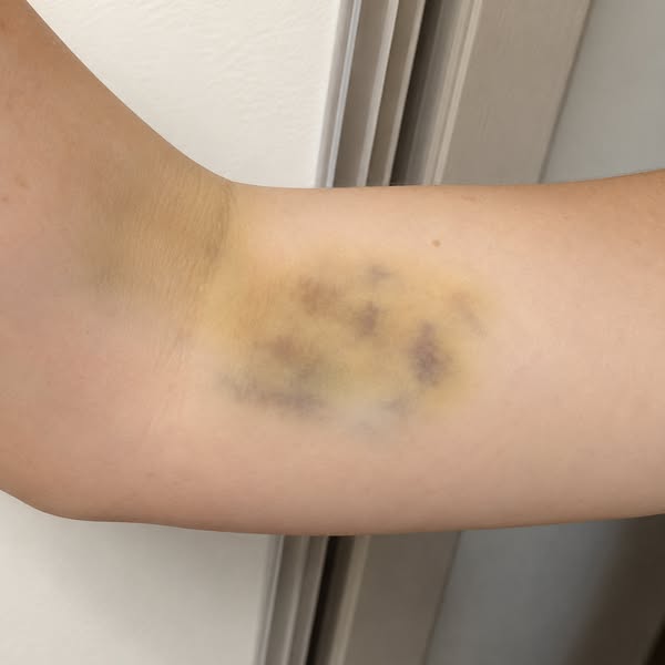 Four Years Of “Gout” Wasn’t Gout