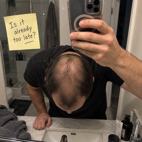 He Quit Finasteride. His Hair Grew Back Anyway.