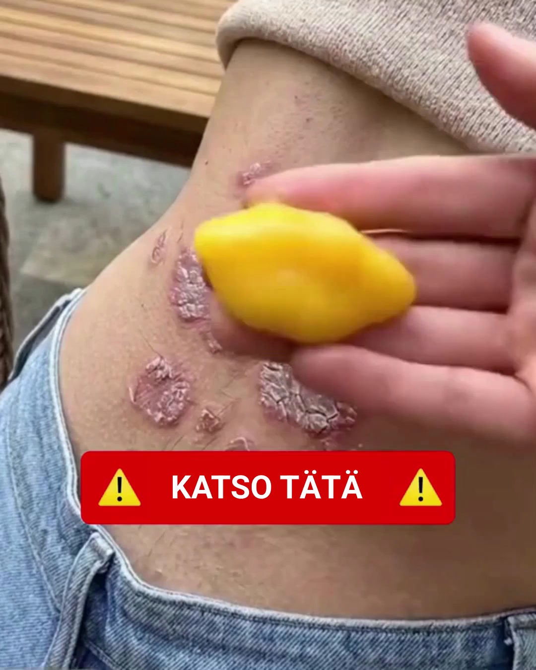 Luonnollinen voide, joka vihdoin lievittää kutinaa