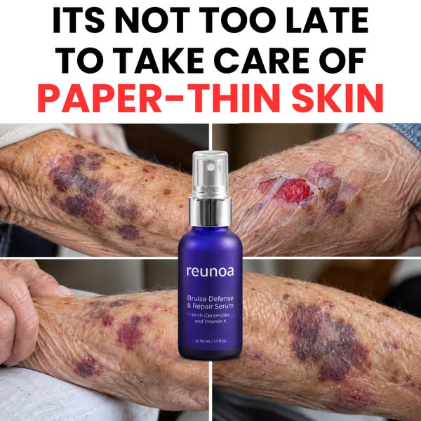Bruises Gone In Days!