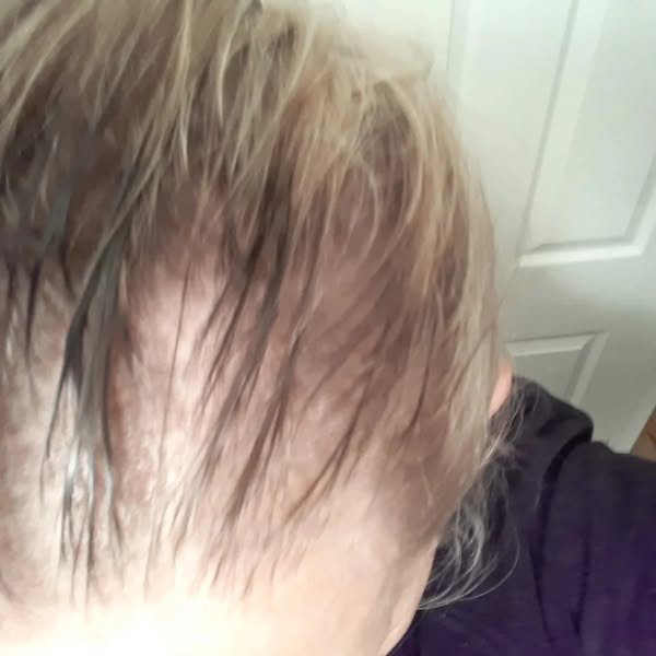 Mom's Hair Was Gone By 70. I Just Found My Scalp Showing At 66